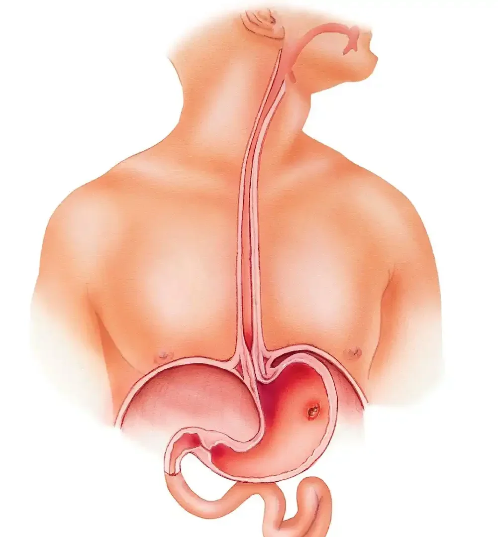 ยูคิวแมค แก้โรคกรดไหลย้อน แสบร้อนกลางอก เรอเหม็นเปรี้ยว จุกแน่น ขมคอ กรดเกินในกระเพาะ อาหารไม่ย่อย ท้องอืด